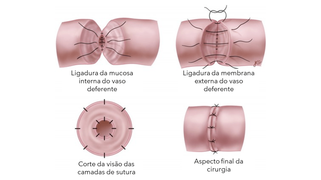 REVERSAO DE VASECTOMIA EM CURITIBA TRATAMENTO