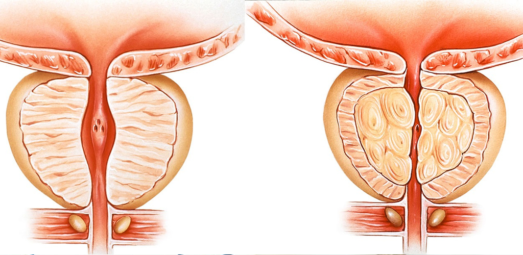 HIPERPLASIA (AUMENTO) DA PRÓSTATA