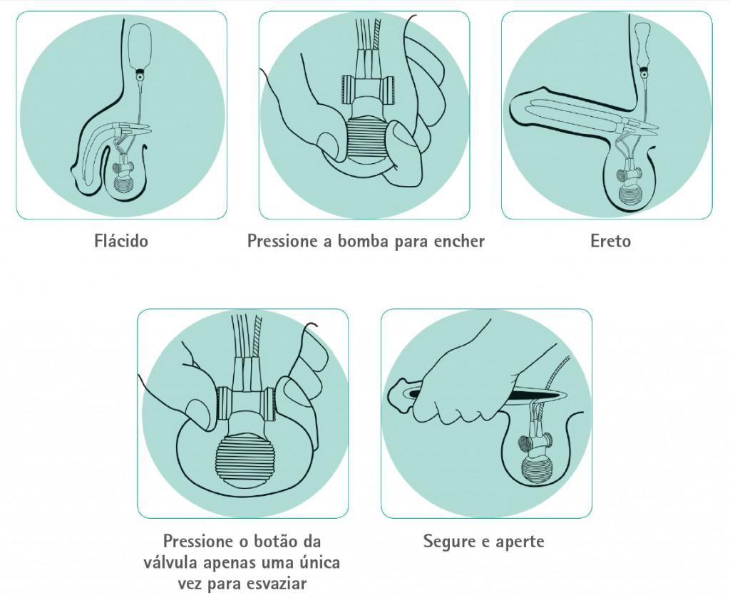 COMO FUNCIONA O IMPLANTE PENIANO 