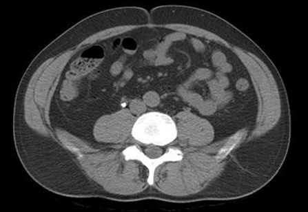 Calculo-no-ureter-direito TRATAMENTO DO CÁLCULO RENAL EM CURITIBA