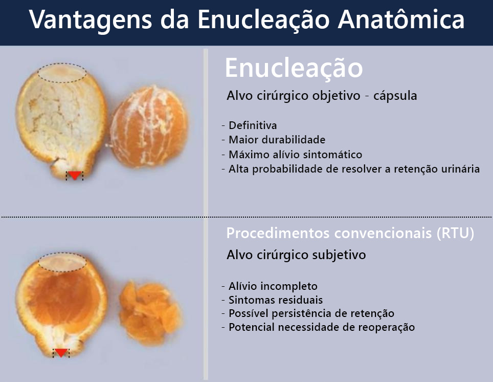 DIFERENCA-ENTRE-RessecCAO-Trans-uretral--E-A-ENUCLEACAO DIFERENCA-ENTRE-RessecCAO-Trans-uretral--E-A-ENUCLEACAO