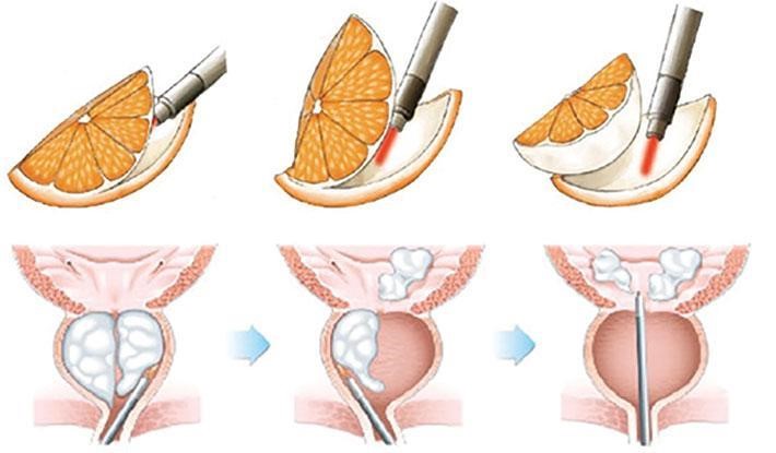 ENUCLEACAO DE PROSTATA EM CURITIBA Nas chamadas “Enucleações”, todo o tecido hiperplásico é retirado, com auxílio do Laser (HoLEP) ou do Plasma (BipoLEP)
