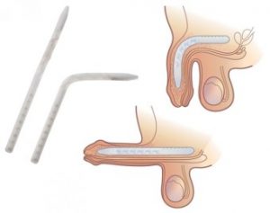 Implante peniano com haste flexível