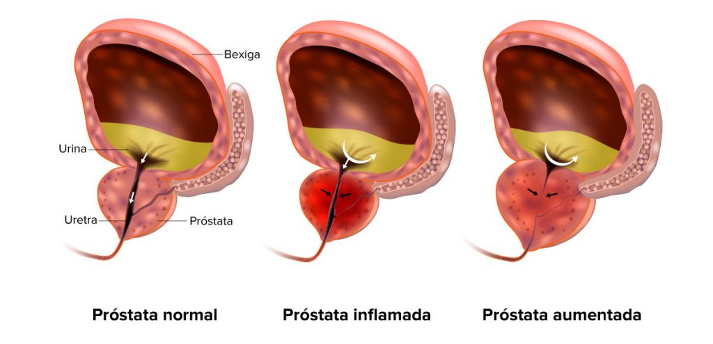 TRATAMENTO DA HIPERPLASIA PORSTATICA CURITIBA TRATAMENTO DA HIPERPLASIA PORSTATICA EM CURITIBA