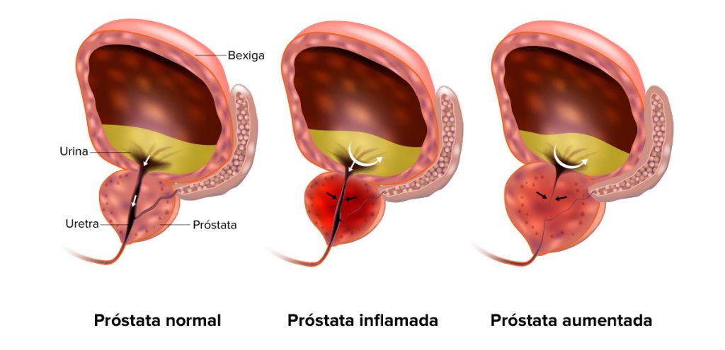 TRATAMENTO DA HIPERPLASIA PORSTATICA EM CURITIBA