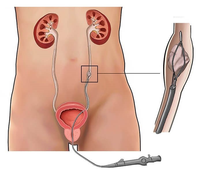 TRATAMENTO DO CALCULO RENAL EM CURITIBA