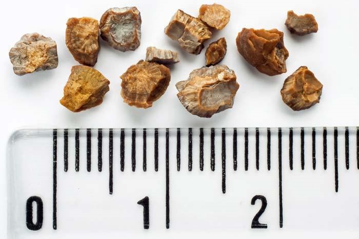 TRATAMENTO DA NEFROLITÍASE EM CURITIBA 1 TRATAMENTO DA NEFROLITÍASE EM CURITIBA