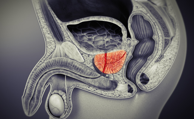 TRATAMENTO DO CANCER DE PROSTATA EM CURITIBA