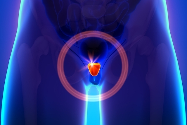TRATAMENTO DO CANCER DE PROSTATA EM CURITIBA TRATAMENTO DO CANCER DE PROSTATA EM CURITIBA