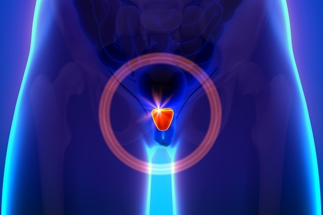 TRATAMENTO DO CANCER DE PROSTATA EM CURITIBA